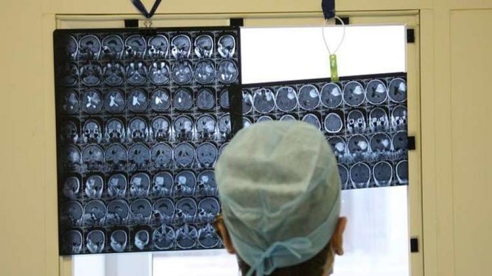 الهند تنجح في إزالة أكبر ورم دماغي