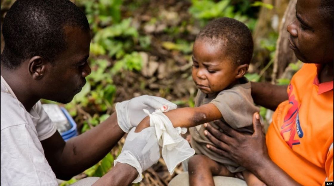 الحصبة تقتل 157 طفلاً في زيمبابوي بأسبوعين، مقابل 12 وفاة عالمية فقط «بجدري قردة»