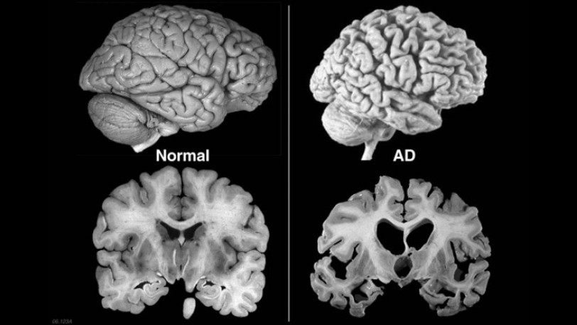 هل سيصبح مرض الزهايمر في خبر كان؟