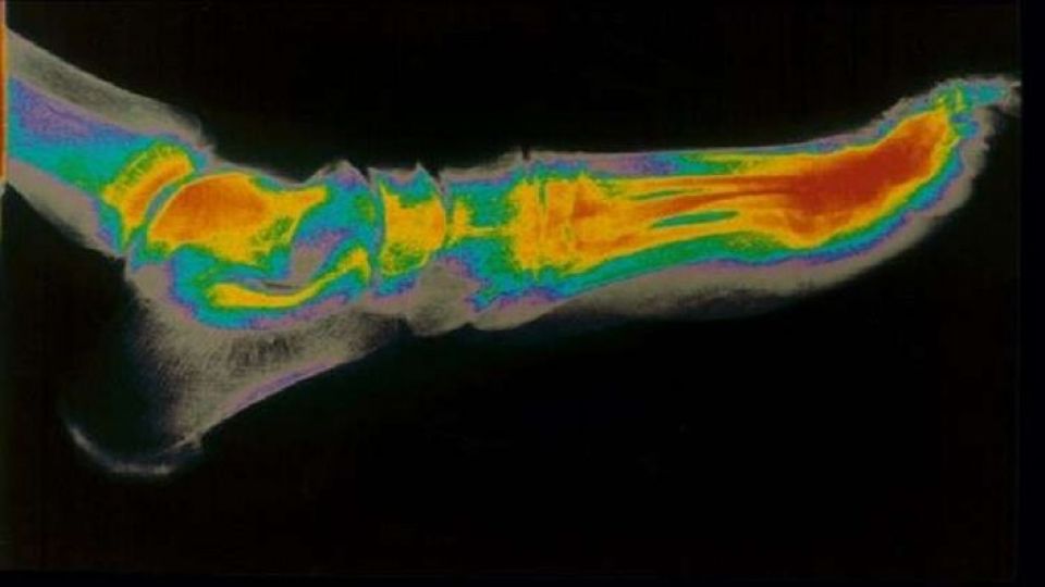 ابتكار يسرّع التئام الكسور ثلاث مرات