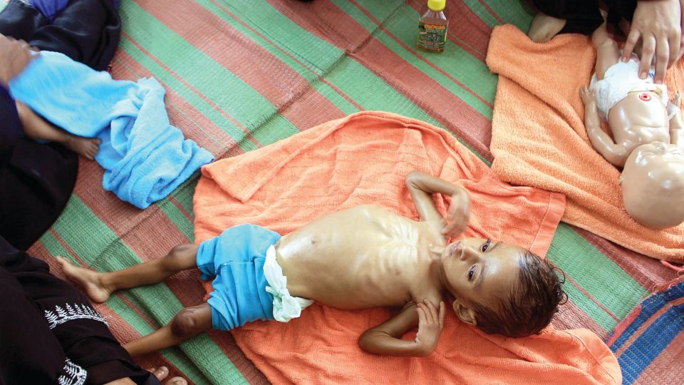 سوء تغذية حاد لدى 2.25 مليون طفلاً دون الخامسة باليمن