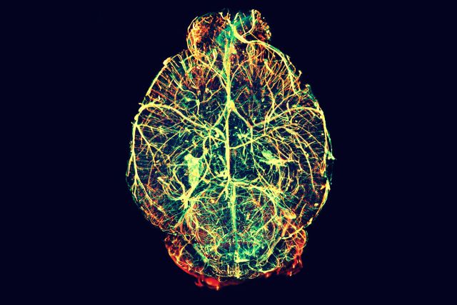 حالياً لا يمكن تشخيص الإصابة بمرض سي.تي.إي إلا في أنسجة دماغ شخص متوفى