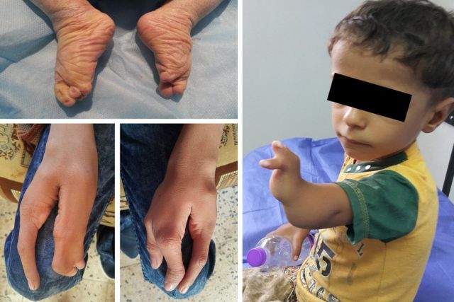 بريطانيا ستسلّح أوكرانيا باليورانيوم المنضَّب المسبّب للسرطان والتشوّهات الولادية