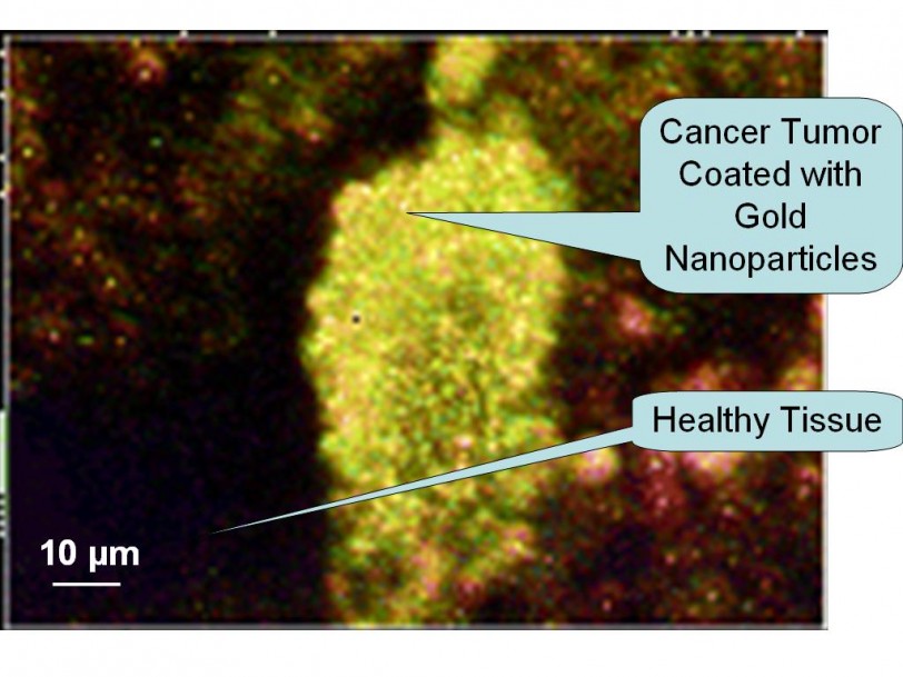 استخدام جزيئات الذهب لعلاج الأورام الخبيثة
