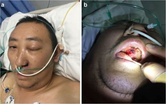 عواقب كورونا سورية: 10 إصابات بـ&laquo;الفطر الأسود&raquo; خلال يومين