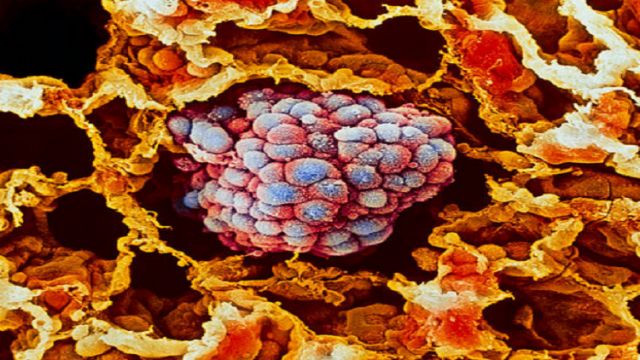 طريقة جديدة لتحفيز المناعة لتدمير السرطان
