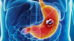 الأطباء يبتكرون طريقة سهلة لتشخيص سرطان المعدة