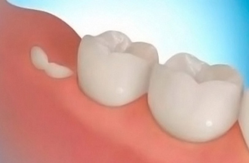 تجديد الأسنان عند البالغين