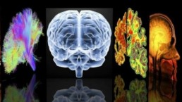 دراسة: تحديد نقطة الضعف في الدماغ المسببة للخرف