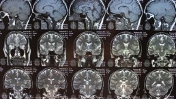 علماء: الفقر يؤثر في حجم الدماغ