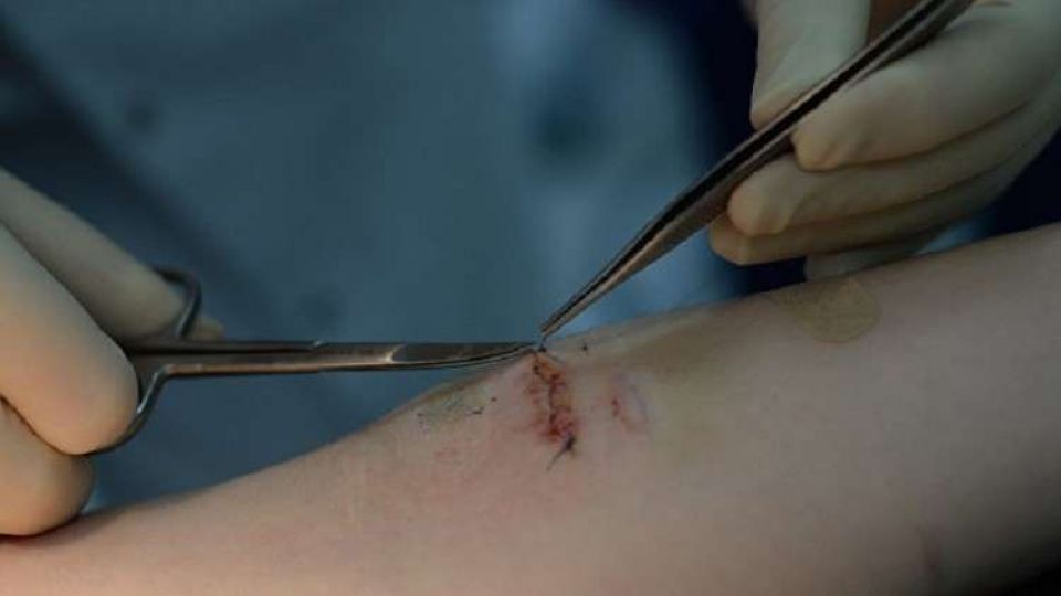 ابتكار جديد يعالج الجروح ولا يخلف ندوباً