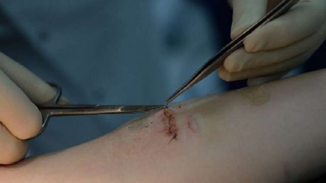 ابتكار جديد يعالج الجروح ولا يخلف ندوباً