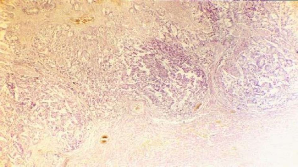 اكتشاف مادة تجبر الجسم على مكافحة السرطان