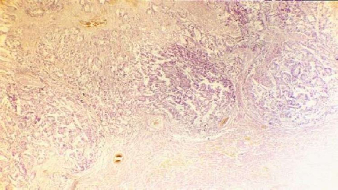 اكتشاف مادة تجبر الجسم على مكافحة السرطان