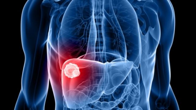 300 مليون شخص يعانون من التهاب الكبد حول العالم